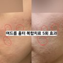 필치과병원 | 여드름 흉터 복합치료 5회 효과 후기 (feat. 유명한 여의도 피부과 )
