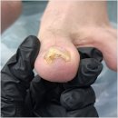 중앙시장(1208) | 목포 산정동 내성발톱 추천하는 이유 루&amp;나 동성제약 풀리메디 목포점