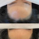 류헤어라인 이미지