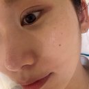 상패123 | 대구피지 여드름 관리 'B10에스테틱' 모공완전청소 받은 후기