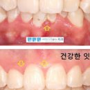 잇몸 부었을때 잇몸 내려앉음 잇몸 염증 잇몸 고름주머니 이미지