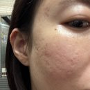 센텀약국 | 얼굴 패인흉터 새살침관리, 부산 센텀피부과 서브시전 추천 내돈내산 후기