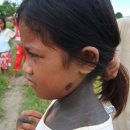 온몸에 점 번지는 8살 필리핀 소녀 `충격` 이미지
