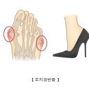 무지외반증[Hallux valgus] 근골격 질환이란? 이미지