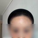 울산휘엘뷰티smp 헤어라인문신2차후기