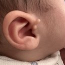 아기 귀젖 &#34;스킨텍&#34; 절개 후기 (아이앤힐성형외과), 국소마취