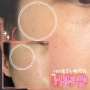 헤라헤어샵 | 뷰티엠 ] 기미 주근깨 잡티 효과 톡톡히 봤다 | before &amp; after 전후사진 비교컷 | 콜드플라즈마 솔직후기