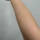 대전 레이저제모 팔, 다리 1회차 내돈내산 후기 가격(젠틀맥스 프로 플러스)
