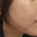 신논현역 피부과에서 리쥬란힐러 4cc 첫 시술 후기