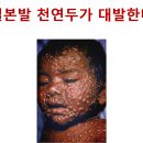 일본발 천연두가 대발한다 이미지