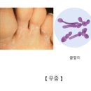 무좀(Tinea pedis)피부질환이란? 이미지