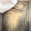 촘촘 스칼프 이미지