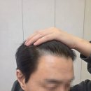 탈모의해답 | 40대 남성 M자탈모 두피생장술 5개월 경과