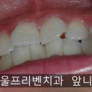 서울프리벤치과의원 네이버블로그