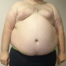 비만[obesity] 이미지