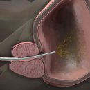 방광암의 치료 과정에서 항암제 또는 BCG 주입 치료 ​ 이미지