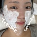 부산 해운대 센텀 여드름 흉터 치료 트러블 컨택터 후기