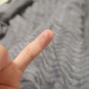고데기로 인한 열상 이미지