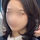대구 블루미의원 프락셀듀얼후기 동성로여드름치료(솔직후기)