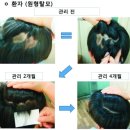 [진주탈모치료 후기]남성 원형탈모치료후기-인삼당한의원