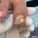 레푸스서초교대역점 | 교대역 문제성 발톱 전문 레푸스 서초교대역점에서 무좀발톱 스케일링 대만족후기