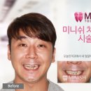 미니쉬치과기공소 네이버블로그