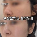 이건레이져 | 선정릉역피부과 실펌x 레이저 후기, 모공 기미 효과 포텐자 통증 비교