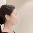 프라임 | 내돈내산 프라임 레이즈 90Kj 후기｜홍대 피부과