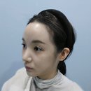팅커벨 | 누운귀필러 귓볼필러인 팅커벨필러 후기