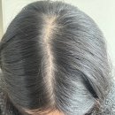 10년차 여성탈모 극복 후기, 가장 효과있었던 방법은?- 윤태영모발피부과의원(내돈내산)