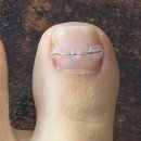 그랜드메디칼 | 내성발톱 관리 푸스케어 평택고덕점 고통 해방 후기