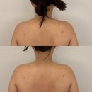 미당 에스테틱 | 안산웨딩관리 이로에스테틱, 웨딩촬영 전 승모관리, 쇄골발굴성공!