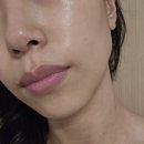수원시청역피부과 리프팅 관리 텐써마 300샷 받아본 후기와 효과, 아픈 정도!