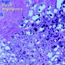 Vascular Breast tumors 이미지