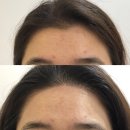 헤어데코 | [시지왁싱 경산왁싱 아르데코뷰티솔루션] 헤어라인왁싱 후기