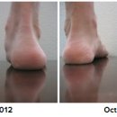 Forefoot Varus and Overpronation 이미지