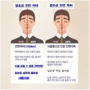 ■ 구안와사(口眼喎斜), 안면마비(Facial Palsy) 이미지