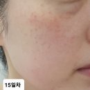 대구 신세계가정의학과의원 주근깨,기미,잡티 레이저 시술 후기(9일차~ 현재) 내돈내산 리얼후기