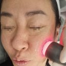 이브 | 논현역의원/ 중안부리프팅 이브타이탄 후기
