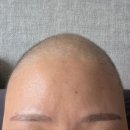 유방5통 | #유방암 일기_11 :: 유방암 전절제 수술 후 첫 검진 , 항암 후 머리길이 변화