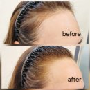 오드리 헤어 | 창원SMP 창원탈모관리 성원주상가 오드리햅번 헤어라인 시술 후기