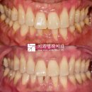 원주치과의원 | 원주 치과 치료후기_착색제거술 및 치경부 마모증 치료 방법은?