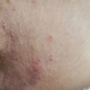 백선 | 사타구니 체부 백선? 습진? 가려움 원인 및 셀프 치료 후기