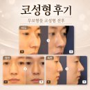 맑은연세의원 | 30대 남성 코성형 후기｜보형물 없이 매부리코를 교정한 코성형 전후
