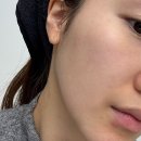 탄생 | 홍대 피부과 리쥬란 에버클 탄생주사 솔직후기