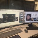눈밑지방 눈밑고랑 고민 끝 | 압구정피부과 리리핏으로 눈밑 진짜 달라졌어요!