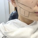 강남역 신논현역 피부과 슈링크 300샷 후기 리프팅 효과