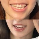 울산플러스치과의원 | 울산 무삭제라미네이트 추천!런던의오후치과 내돈내산, 자연스러운 치아 완성 후기