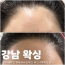 박헤어라인 - 서구 | 신사동왁싱 키라왁싱에서 헤어라인왁싱 리얼 후기