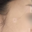 스타미피부과의원 | 백반증 치료